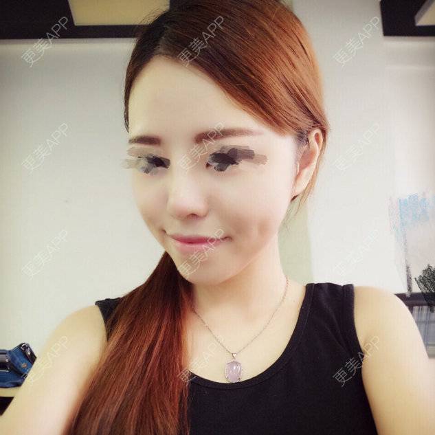 更美 - 哈哈baby的隆鼻经验 | 硅胶隆鼻 | 隆鼻 | 鼻部多项 | 美购日记 | 自体软骨垫鼻尖 | 广州
