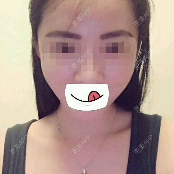 更美 - 曾浩 医生的经验 | 眉毛种植 | fue眉毛 | 眼部整形 | 广州
