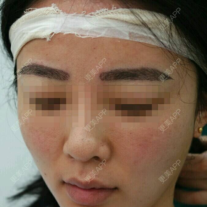 更美 - 曾浩 医生的经验 | 眉毛种植 | fue眉毛 | 眼部整形 | 广州