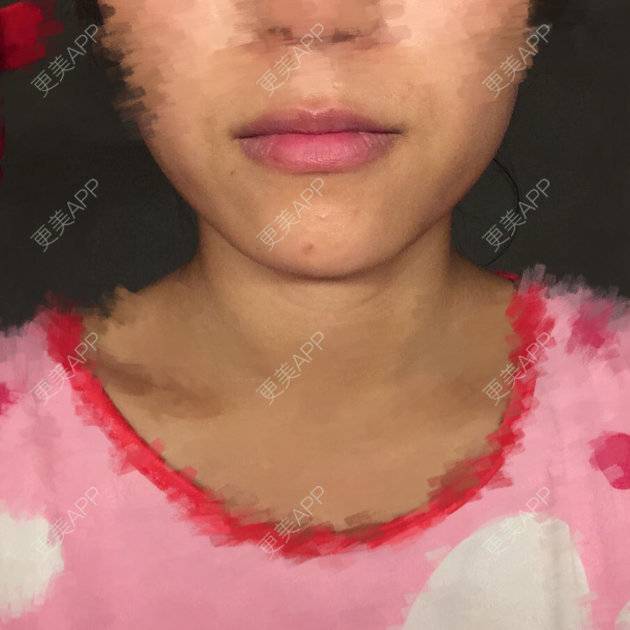 更美 - 一一是我大宝贝儿呐的经验 | 注射美容 | 除皱瘦脸 | 保妥适
