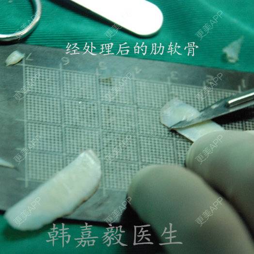 更美 - 韩嘉毅 医生的经验 | 肋软骨隆鼻 | 上海
