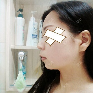 虽然只有88斤但是脸看着肉肉的后来发现是自己下巴短而且后缩侧面特别