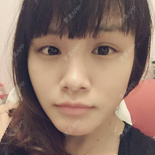 更美 - Carol的经验 | 韩式三点双眼皮 | 埋线双眼皮 | 内双 | 桂林