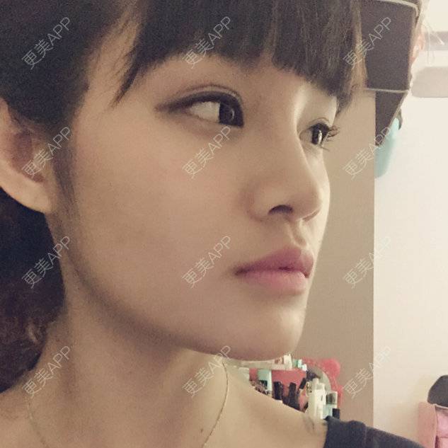 更美 - Carol的经验 | 韩式三点双眼皮 | 埋线双眼皮 | 内双 | 桂林