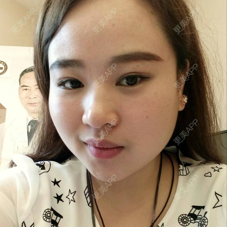 更美 - 更美达人(昆明)的经验 | 伊婉玻尿酸 | 昆明