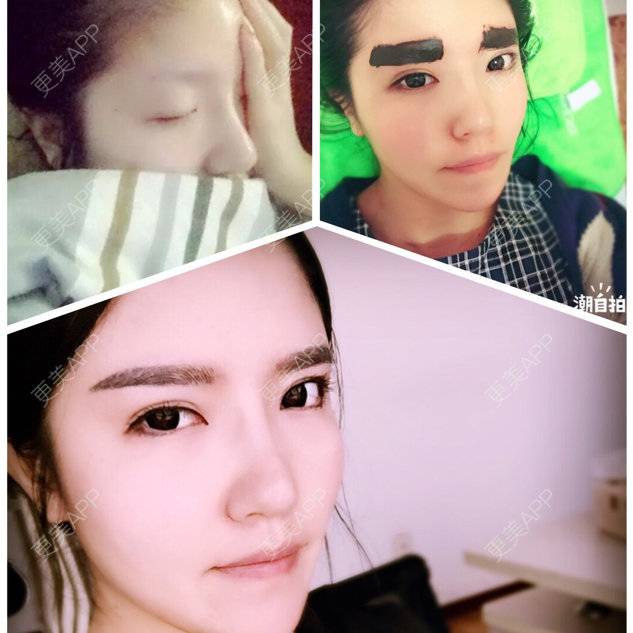 更美 - 大芒果的硅胶隆鼻经验 | 纹眉啦 | 北京