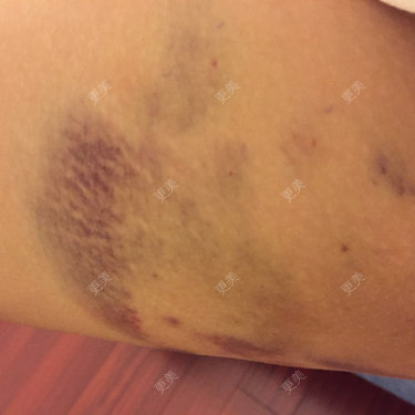 第一次打完溶脂针第二天大腿内侧的淤青越来越严重了是不是有什么问题