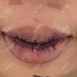 更美 - hippocry的厚唇改薄经验 | 北京