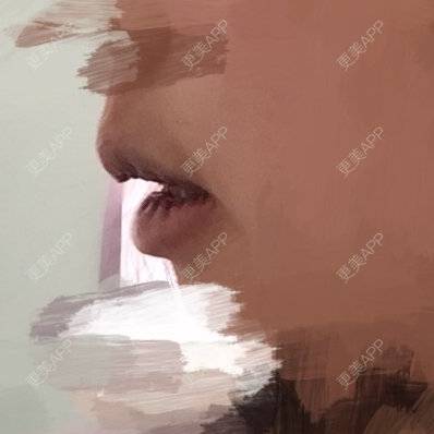 更美 - hippocry的厚唇改薄经验 | 北京