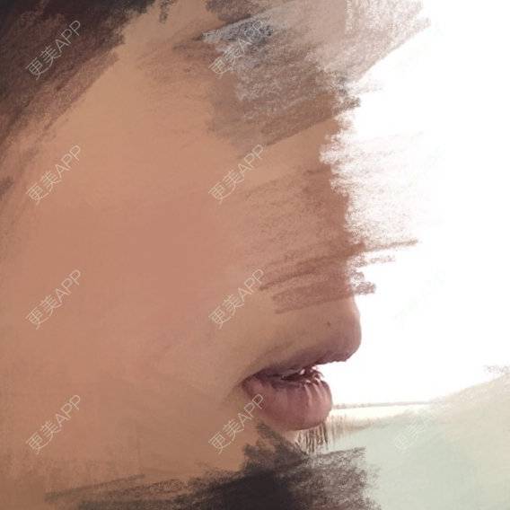 更美 - hippocry的厚唇改薄经验 | 北京