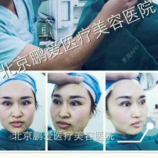 更美 - 北京鹏爱医疗美容诊所的全切双眼皮经验 | 美购日记 | 全切双眼皮 | 北京