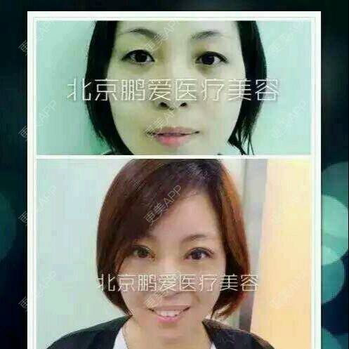 更美 - 北京鹏爱医疗美容诊所的全切双眼皮经验 | 美购日记 | 全切双眼皮 | 北京
