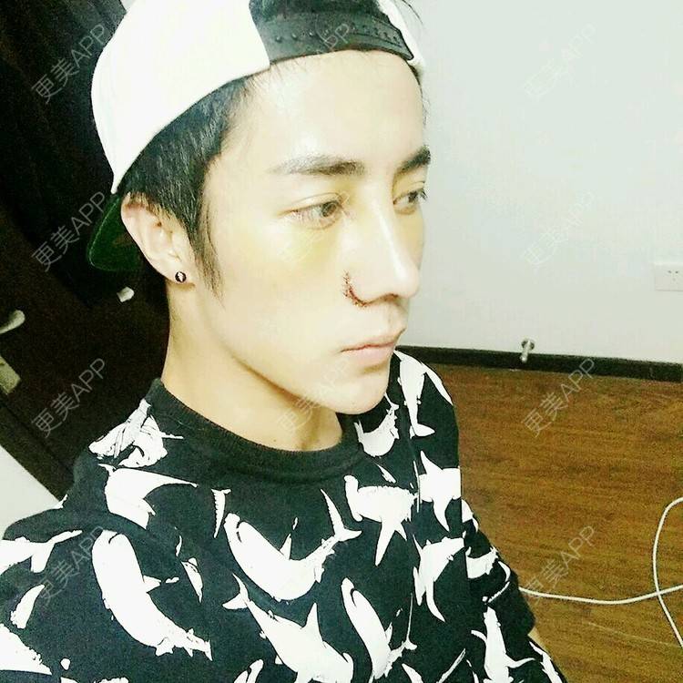 更美 - 逗逼1的鼻部多项经验 | 膨体隆鼻 | 北京 | 自体软骨垫鼻尖 | 鼻部多项 | 美购日记