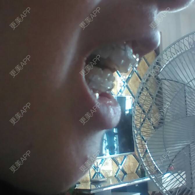 更美 - 更美一直美美的的牙齿矫正经验 | 孝感 | 龅牙 | 牙列拥挤 | 拔牙 | 牙齿矫正 | 蛀牙