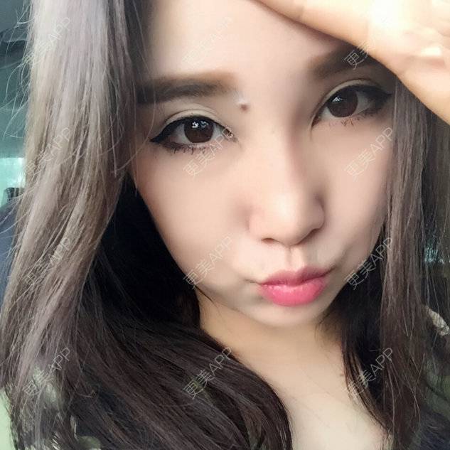 更美 - 🌸bobo‘💉的经验 | 隆鼻