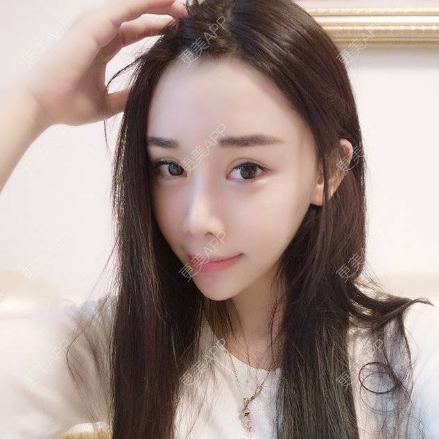 更美 - 范小爷的开外眼角经验 | 玻尿酸卧蚕 | 玻尿酸眉弓 | 玻尿酸法令纹 | 玻尿酸太阳穴 | 硅胶隆鼻 | 鼻中隔软骨垫鼻头 | 玻尿酸唇部 | 自体软骨垫鼻尖 | 除皱瘦脸 | 玻尿酸苹果肌 | 开内眼角 | 开外眼角 | 玻尿酸下巴 | 深圳 | 鼻翼缩小 | 全切双眼皮