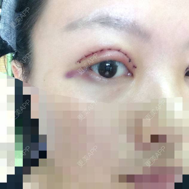 更美 - 短发是一种〜态度?的经验 | 割双眼皮 | 杭州