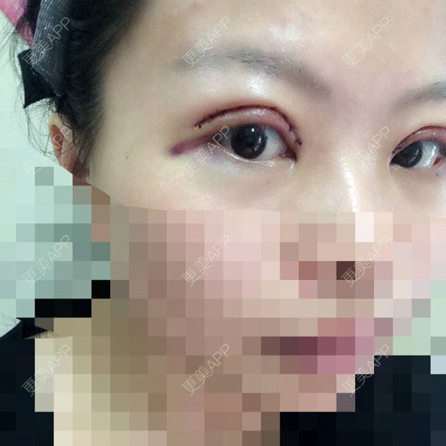 更美 - 短发是一种〜态度?的经验 | 割双眼皮 | 杭州
