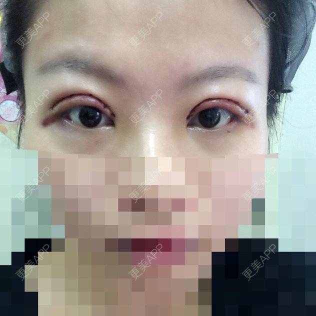 更美 - 短发是一种〜态度?的经验 | 割双眼皮 | 杭州