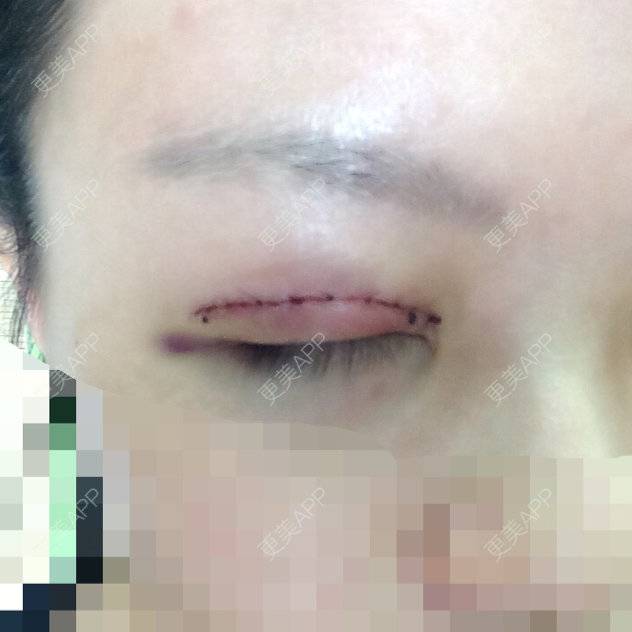 更美 - 短发是一种〜态度?的经验 | 割双眼皮 | 杭州