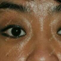 更美 - 是的就他了的全切双眼皮经验 | 眼部整形 | 唐山 | 全切双眼皮