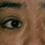 更美 - 是的就他了的全切双眼皮经验 | 眼部整形 | 唐山 | 全切双眼皮