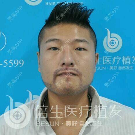 曾浩医生的植胡须日记