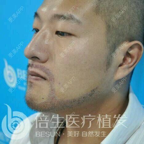 曾浩医生的植胡须日记