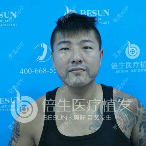 曾浩医生的植胡须日记