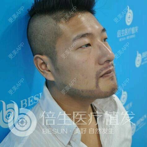 曾浩医生的植胡须日记