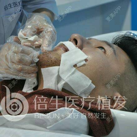 曾浩医生的植胡须日记