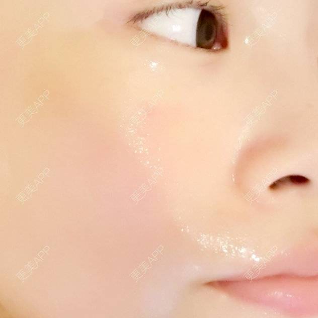 更美 - 更美用户7237075443的水光项目经验 | 水光项目 | 德阳