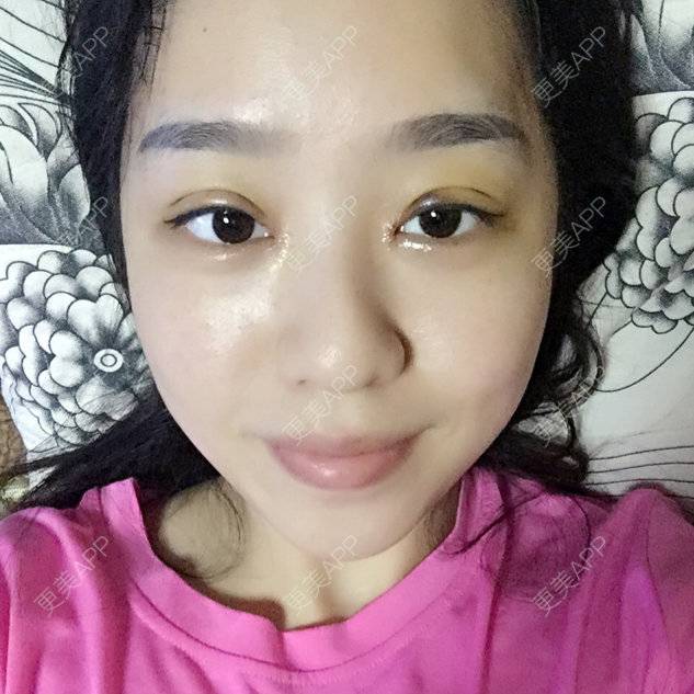 更美 - 曾丽萍💄💗的定点双眼皮经验 | 鄂州