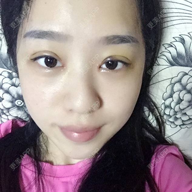 更美 - 曾丽萍💄💗的定点双眼皮经验 | 鄂州