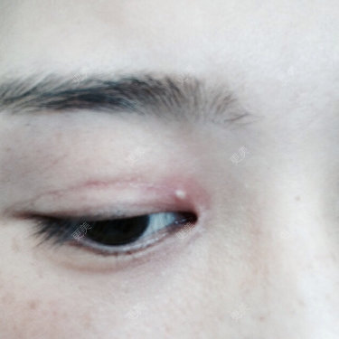 有木有人割完双眼皮眼睛上有白疙瘩你们是怎么处理的