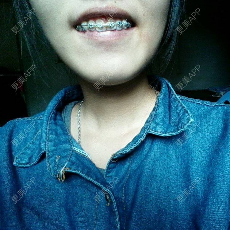 更美 - 不是公主命、的牙齿矫正经验 | 牙列拥挤 | 牙齿矫正 | 莆田 | 龅牙 | 虎牙