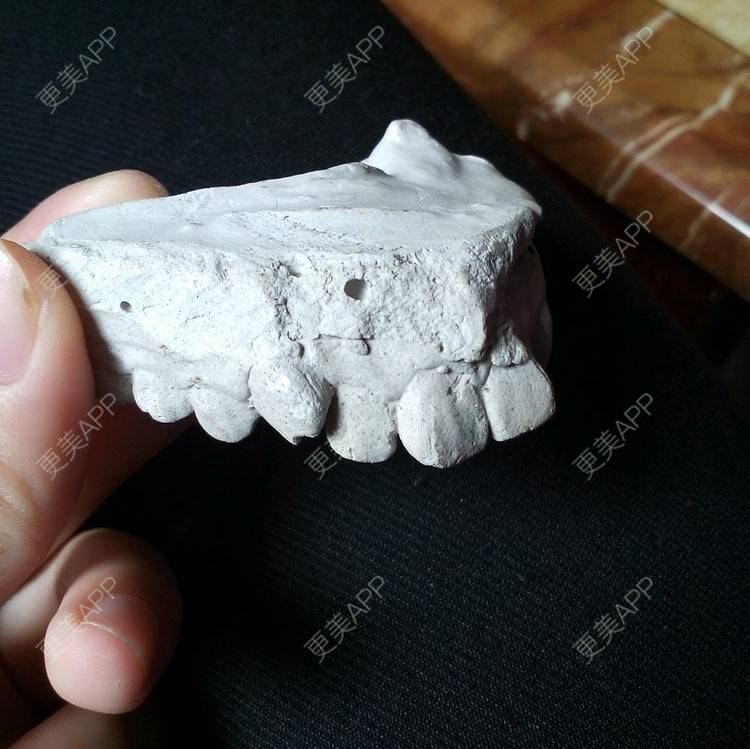 更美 - 不是公主命、的牙齿矫正经验 | 牙列拥挤 | 牙齿矫正 | 莆田 | 龅牙 | 虎牙