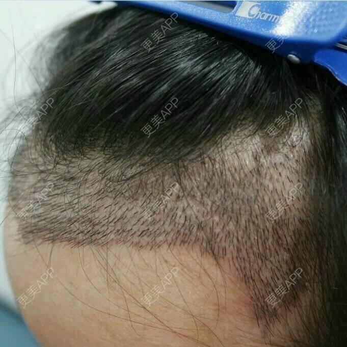 更美 - 为什么我不能叫娃哈哈的植发际线经验 | 广州 | 发际线调整 | 大饼脸缩小术 | 大脸变小脸 | 植发际线
