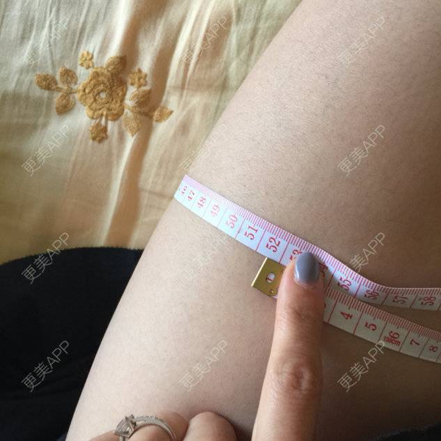 更美 - 梦想筷子腿的除皱瘦脸经验 | 除皱瘦脸 | 合肥 | 注射塑形腿部