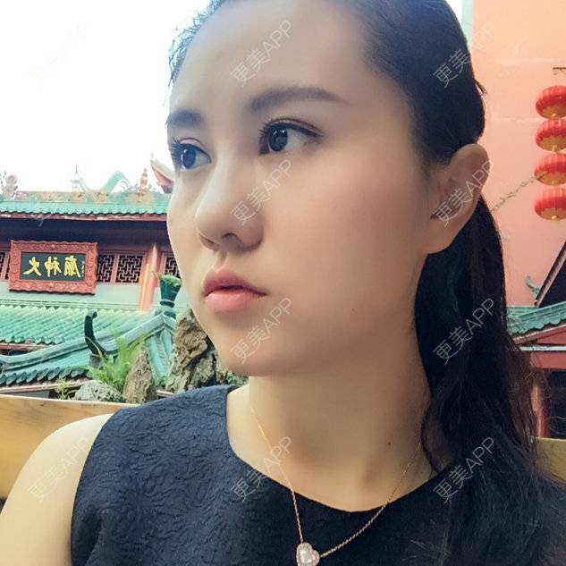 更美 - 更美用户8I2veax3Vs的眼部其他项目经验 | 眼部其他项目 | 注射除皱针打鱼尾纹
