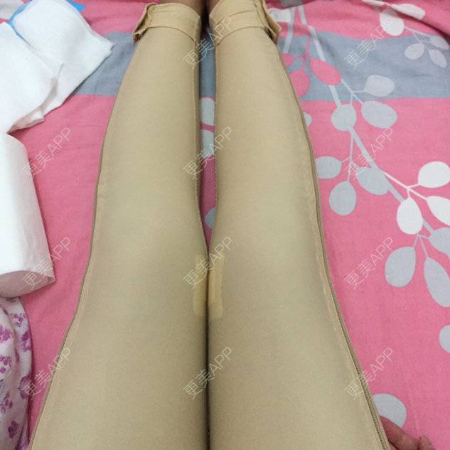 更美 - 蒙面姑姑的吸脂瘦大腿经验 | 自体脂肪丰胸 | 吸脂瘦大腿 | 小腿吸脂 | 自体脂肪隆胸 | 美购日记 | 吸脂塑臀 | 抽脂瘦大腿 | 抽脂瘦小腿 | 深圳