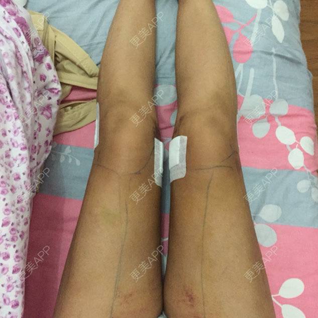 更美 - 蒙面姑姑的吸脂瘦大腿经验 | 自体脂肪丰胸 | 吸脂瘦大腿 | 小腿吸脂 | 自体脂肪隆胸 | 美购日记 | 吸脂塑臀 | 抽脂瘦大腿 | 抽脂瘦小腿 | 深圳
