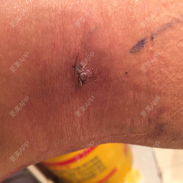 更美 - 蒙面姑姑的吸脂瘦大腿经验 | 自体脂肪丰胸 | 吸脂瘦大腿 | 小腿吸脂 | 自体脂肪隆胸 | 美购日记 | 吸脂塑臀 | 抽脂瘦大腿 | 抽脂瘦小腿 | 深圳