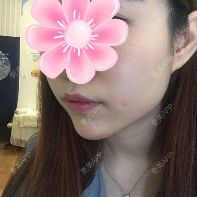 更美 - ˇＹＵ☆的除皱瘦脸经验 | 成都 | 玻尿酸苹果肌 | 玻尿酸下巴 | 除皱瘦脸 | 美购日记