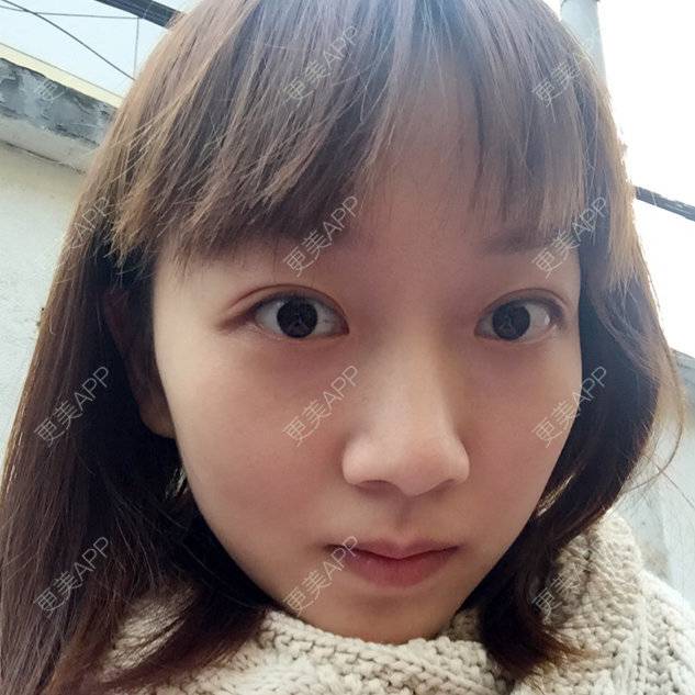 更美 - 纯美馨香的经验 | 玻尿酸免费送 | 免费玻尿酸隆鼻 | 北京