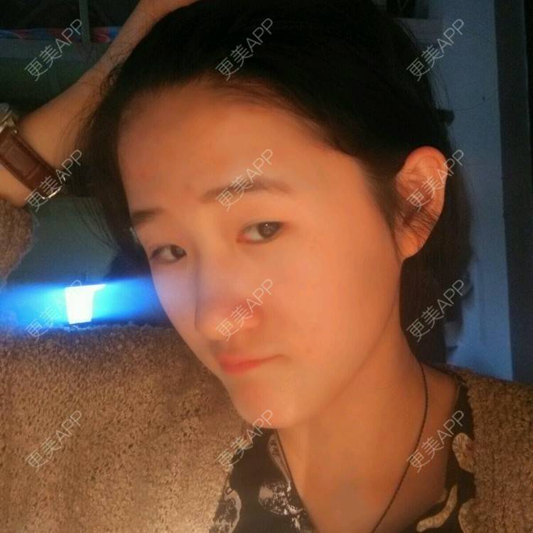更美 - biubiumo的经验 | 伊婉玻尿酸 | 昆明