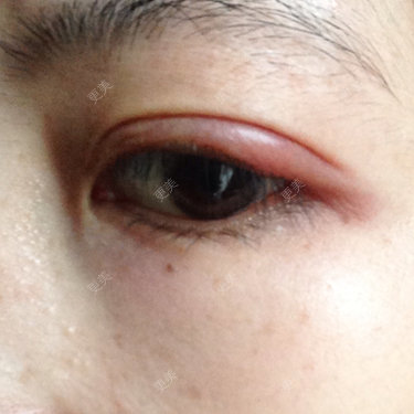 这个双眼皮四个月了前天下午左眼突然肿了请问是怎么回事