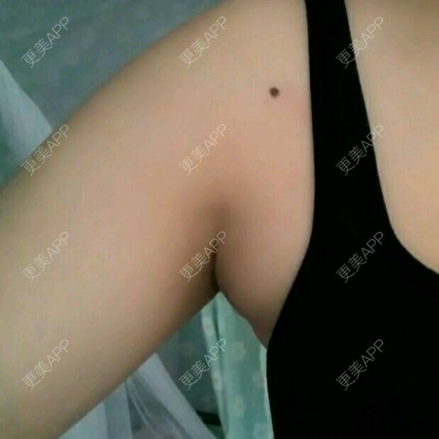 更美 - 一只青蛙跳下水的经验 | 祛副乳 | 南宁