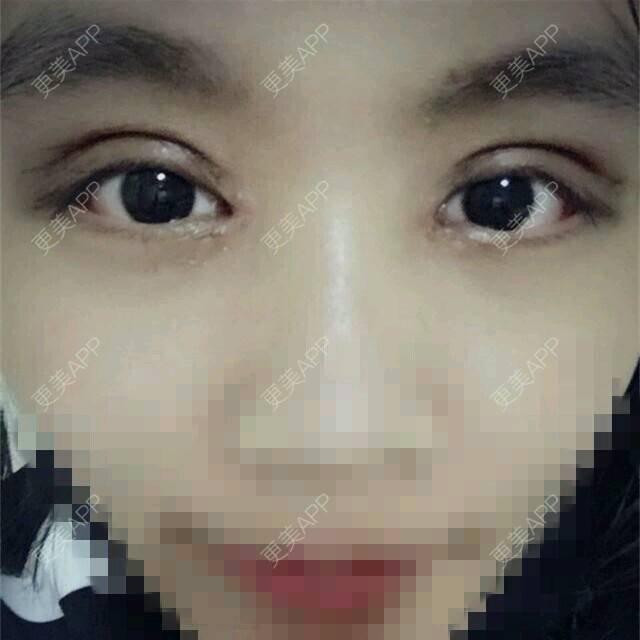 更美 - 乐观的糖糖的定点双眼皮经验 | 开内眼角 | 眉弓脂肪填充 | 改良park双眼皮 | 定点双眼皮 | 上海