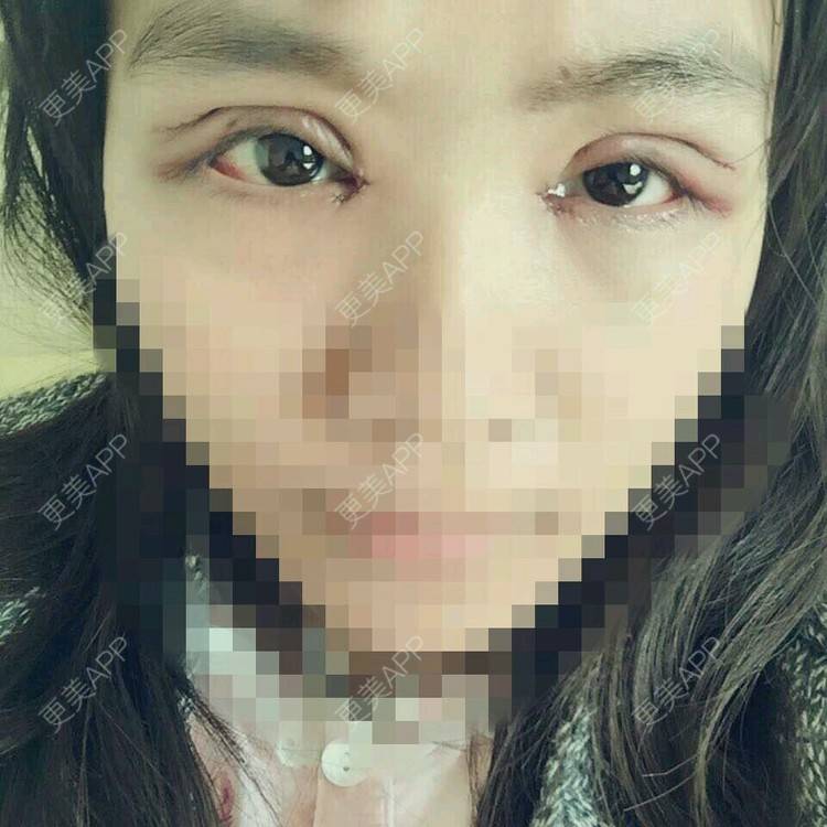 更美 - 乐观的糖糖的定点双眼皮经验 | 开内眼角 | 眉弓脂肪填充 | 改良park双眼皮 | 定点双眼皮 | 上海